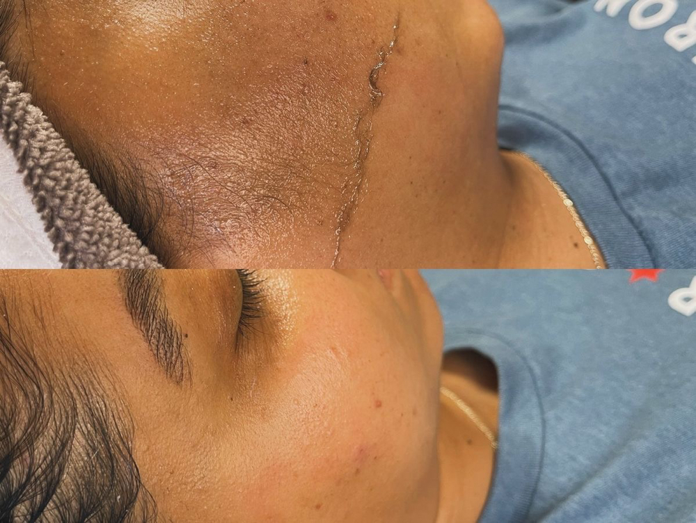 Dermaplane Facial