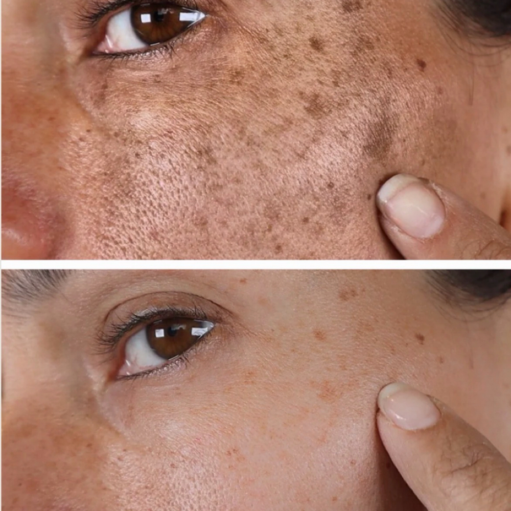 Hiperpigmentacion Program at Laura Fabral Aesthetics in Miami, FL