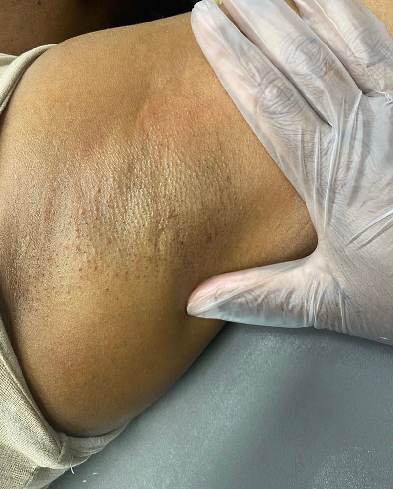 Underarm