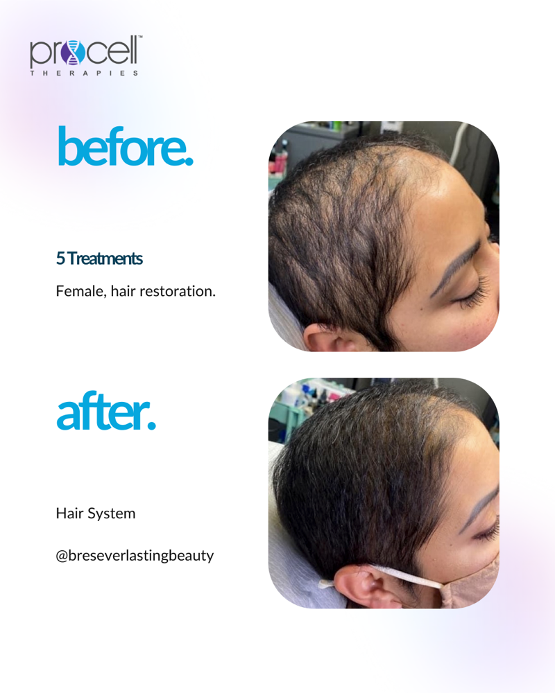 Scalp Microchanneling + Serum at Angel Nails & Beauty Spa in Elk Grove, CA