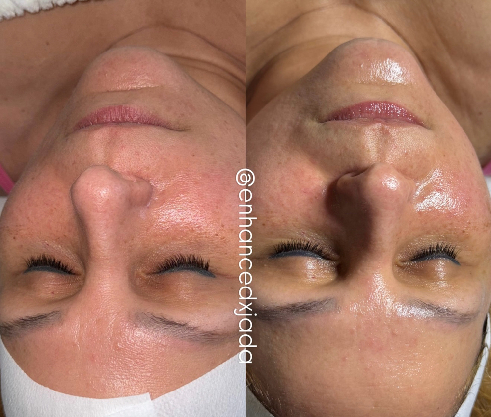 Anti Aging Facial