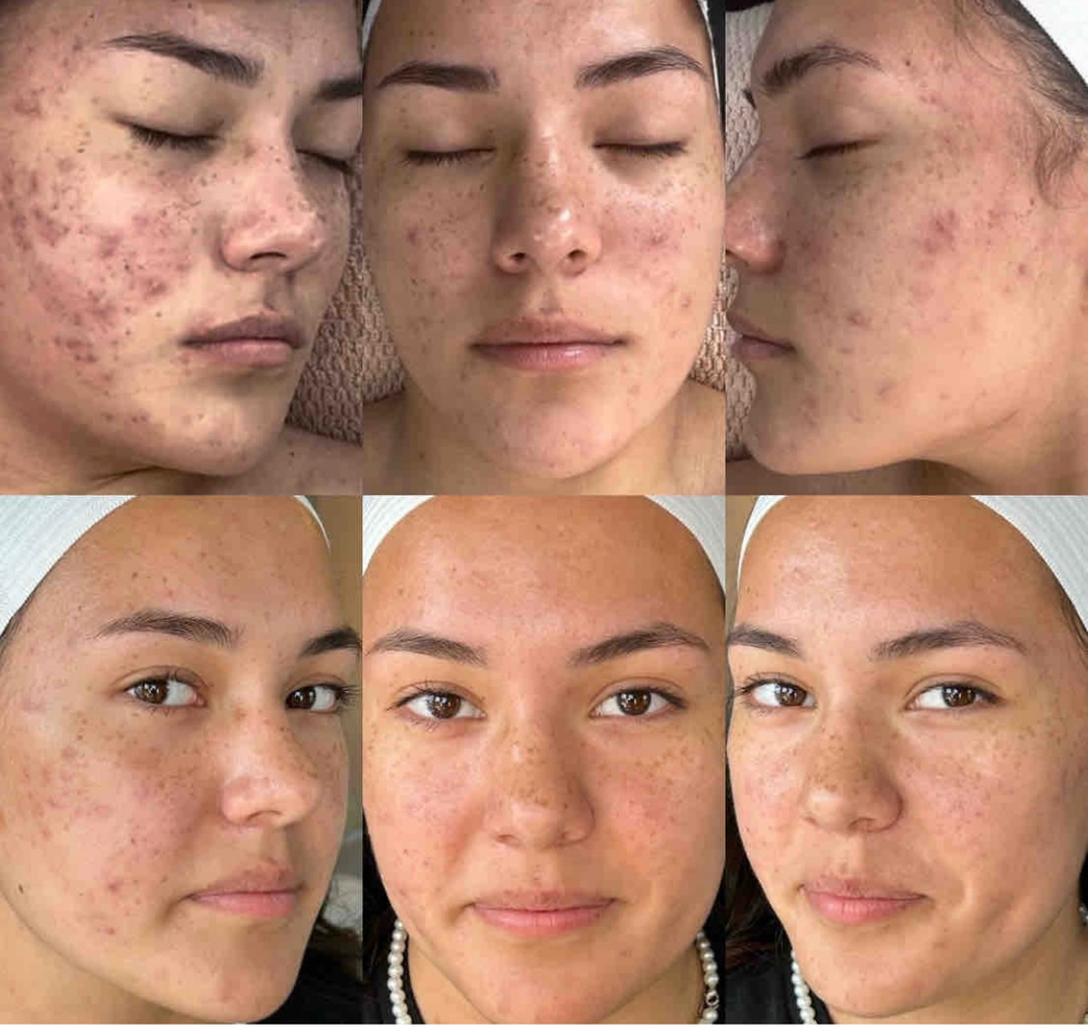 Series: 3 Teen Acne Clearing Facial