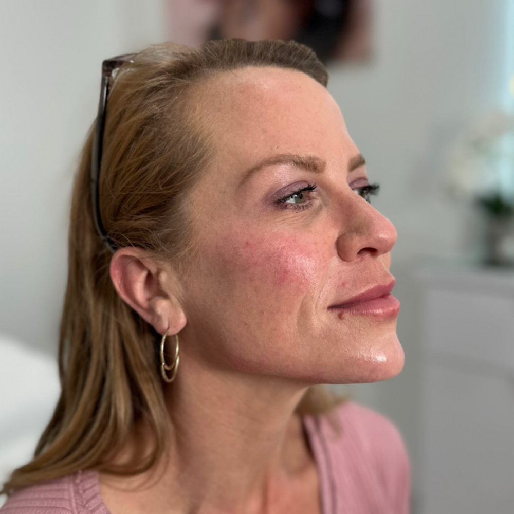 Facial Balancing at Aether Aesthetics in Midland, TX