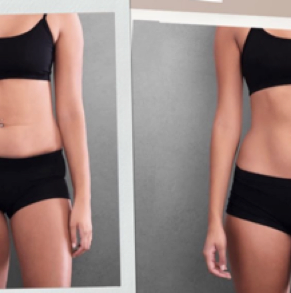 Fat Dissolving Treatment (Medium Ar at Flawless Spa & Beauty in Fort Worth, TX