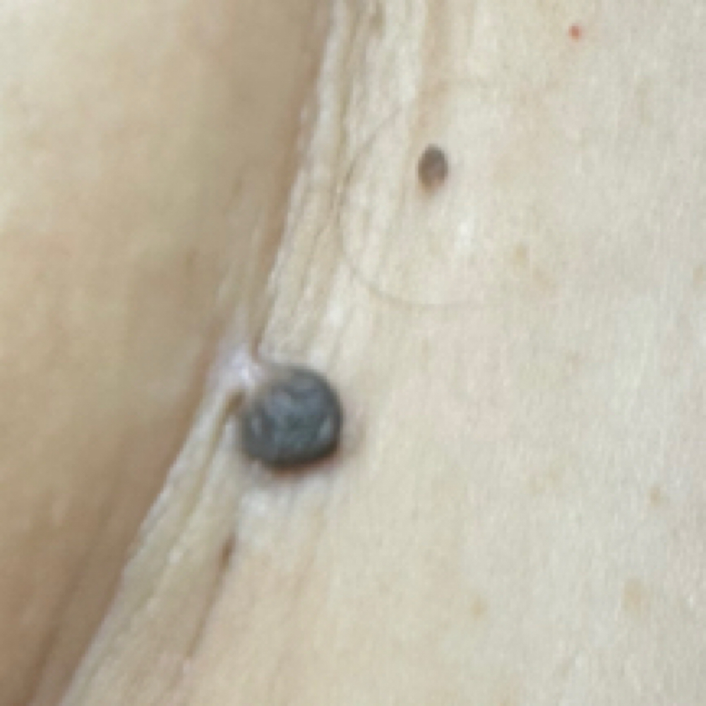 Skin Tag Removal (<5 ) at Peridot Studio in Lubbock, TX