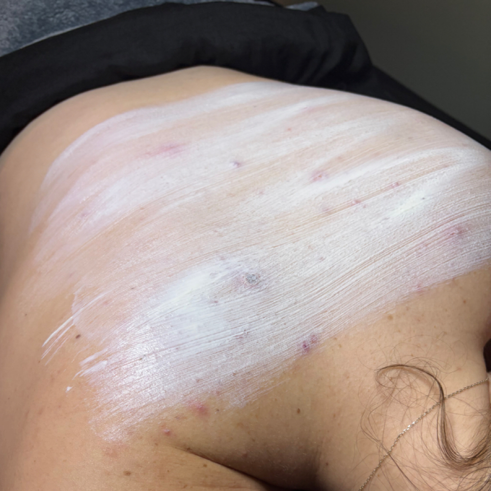 Back Treatment at Renewed Beauty & Esthetics in Louisville, OH