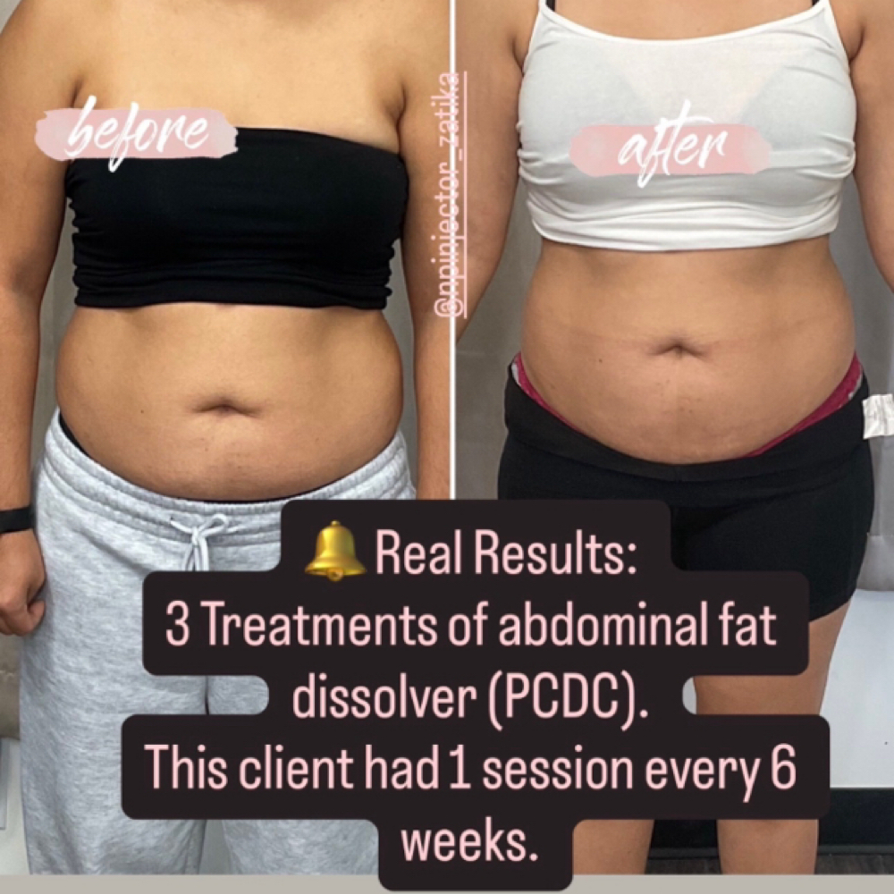 Liquid Lipo (PCDC) at Agoddess Spa & Wellness in DeSoto, TX