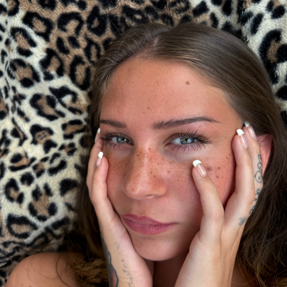 FRECKLES at RIA Aesthetix in Hales Corners, WI