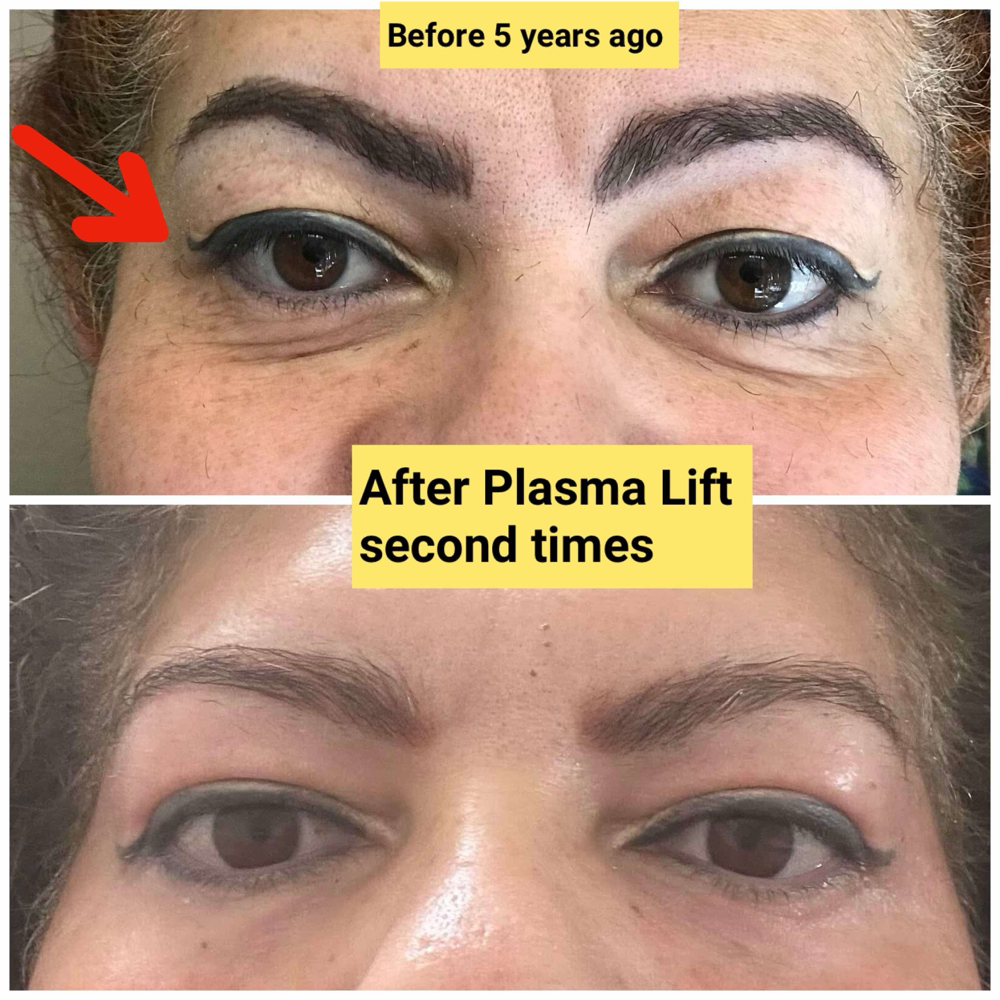 UPPER EYELID LIFT-COLD PLASMA