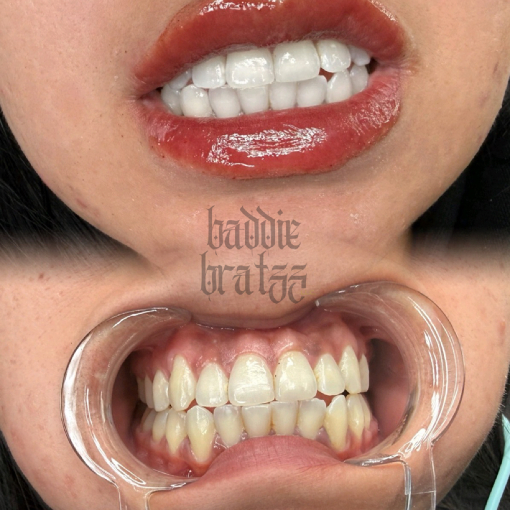 60 Minute Teeth Whitening & 1ml Lip