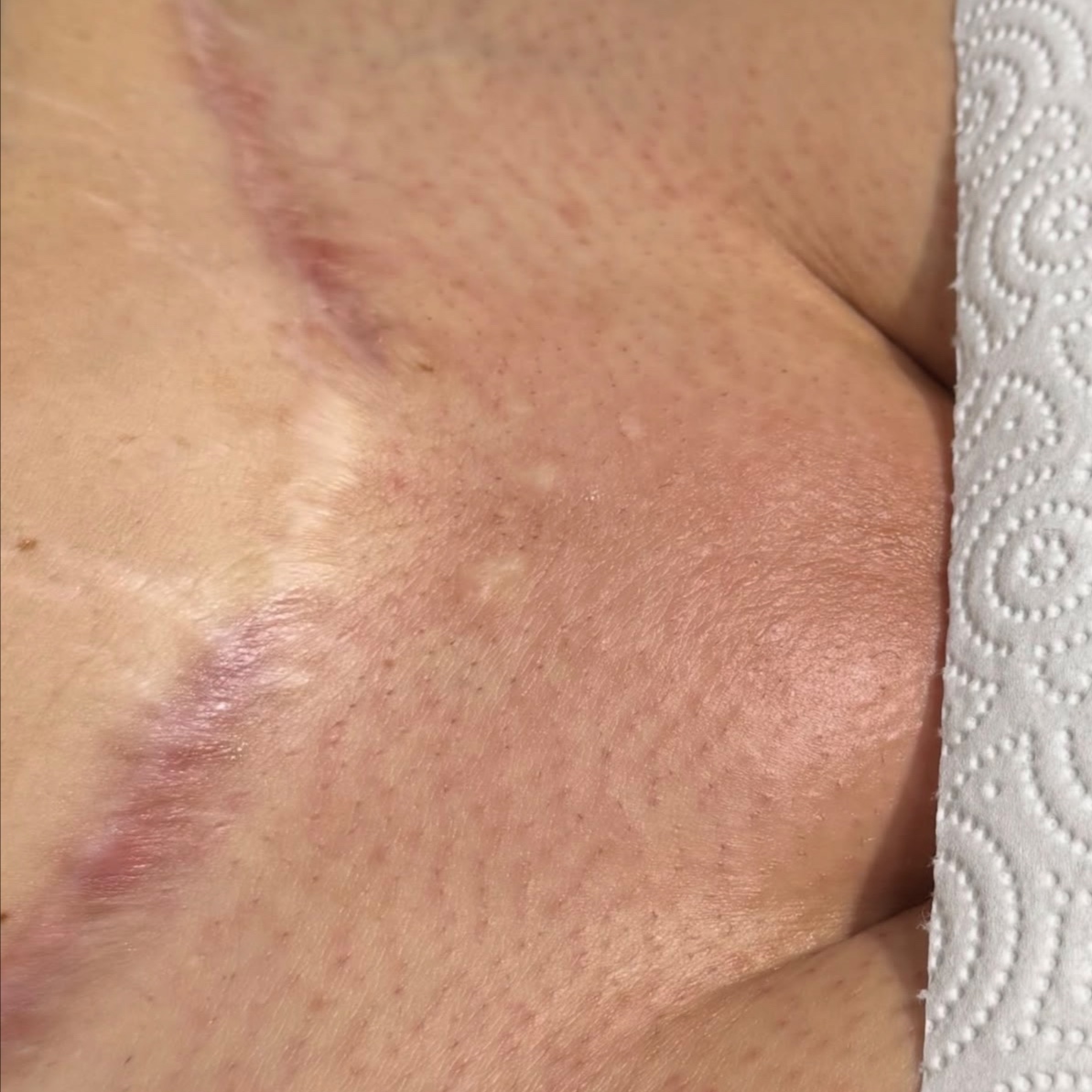 Women Brazilian at HALO SKN ESTHETICS in Killeen, TX