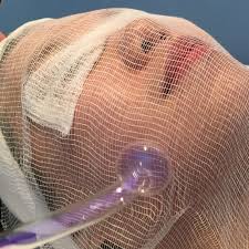 HIGH FREQUENCY FACIAL