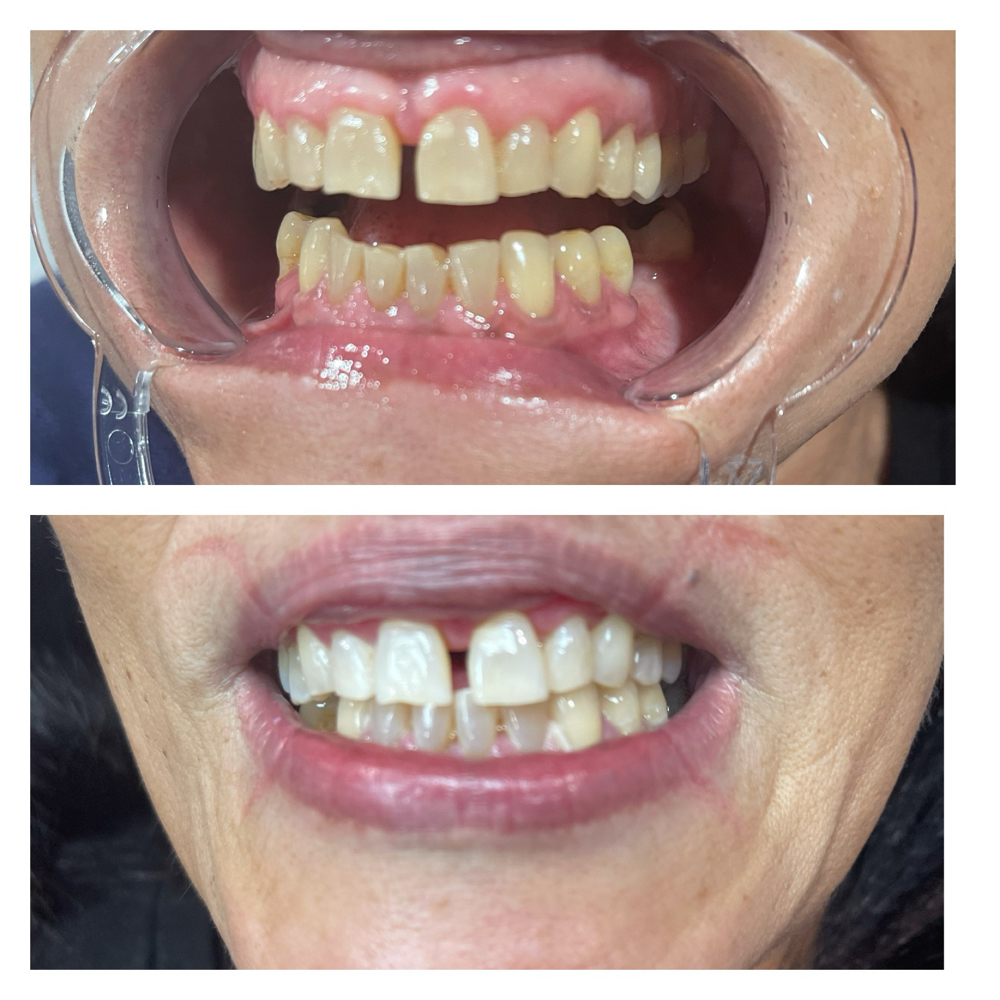 Teeth Whitening