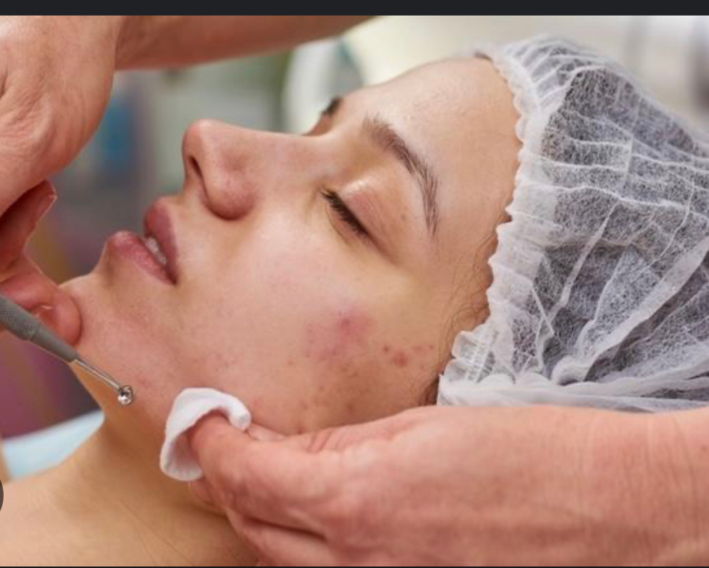 Acne Facial