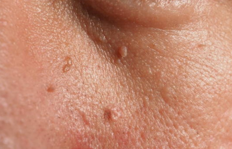Skin Tag Removal