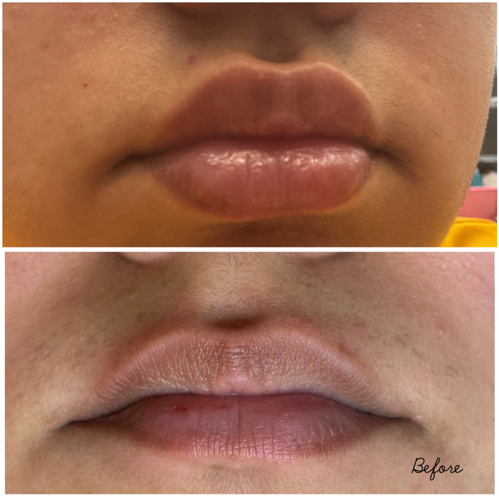 Lip Flip Tox at Le' Spa in McAllen, TX