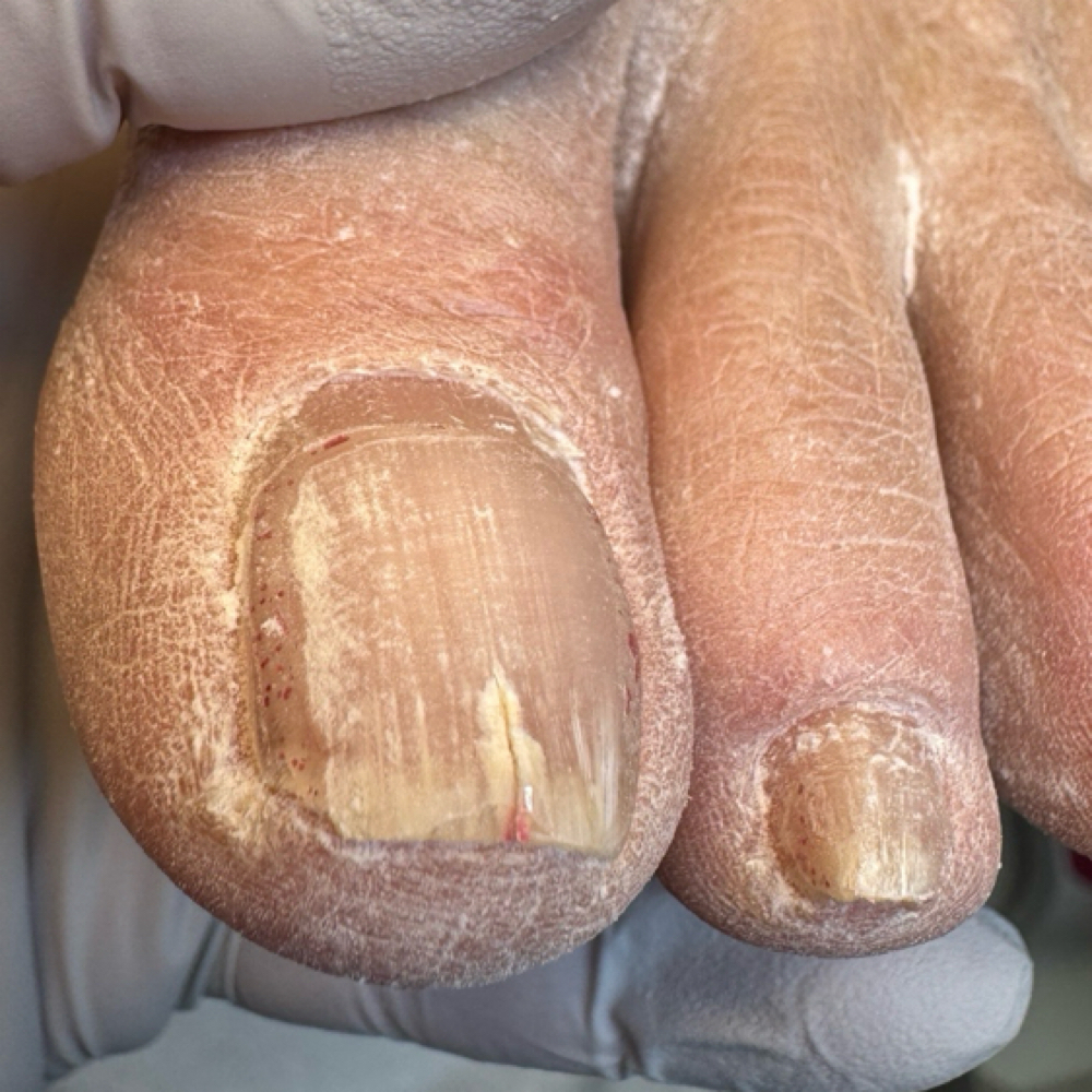 TREATMENT OF 1 COMPLICATED NAIL at Anna Prochukhan in Prairie Village, KS