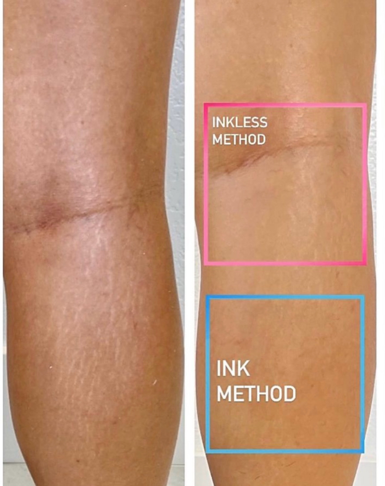 Stretch Mark Camouflage Consult