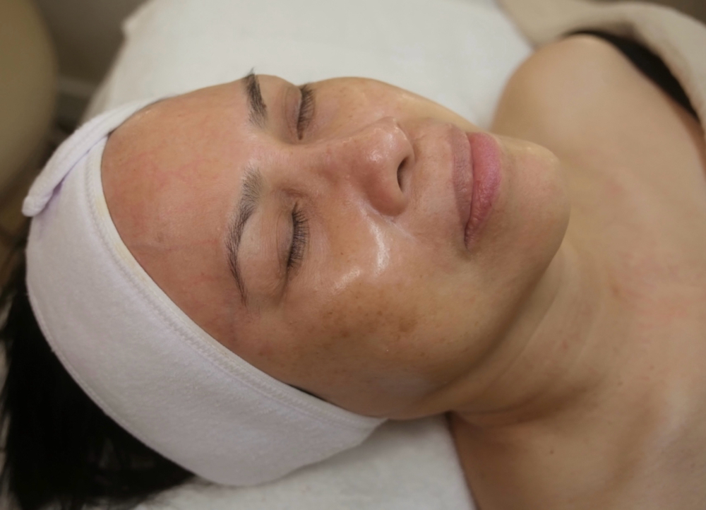 The Hyperpigmentation Peel