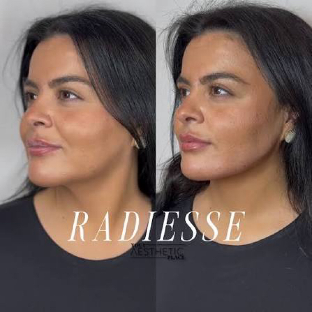 Radiesse at Benlux Aesthetics in Annandale, VA