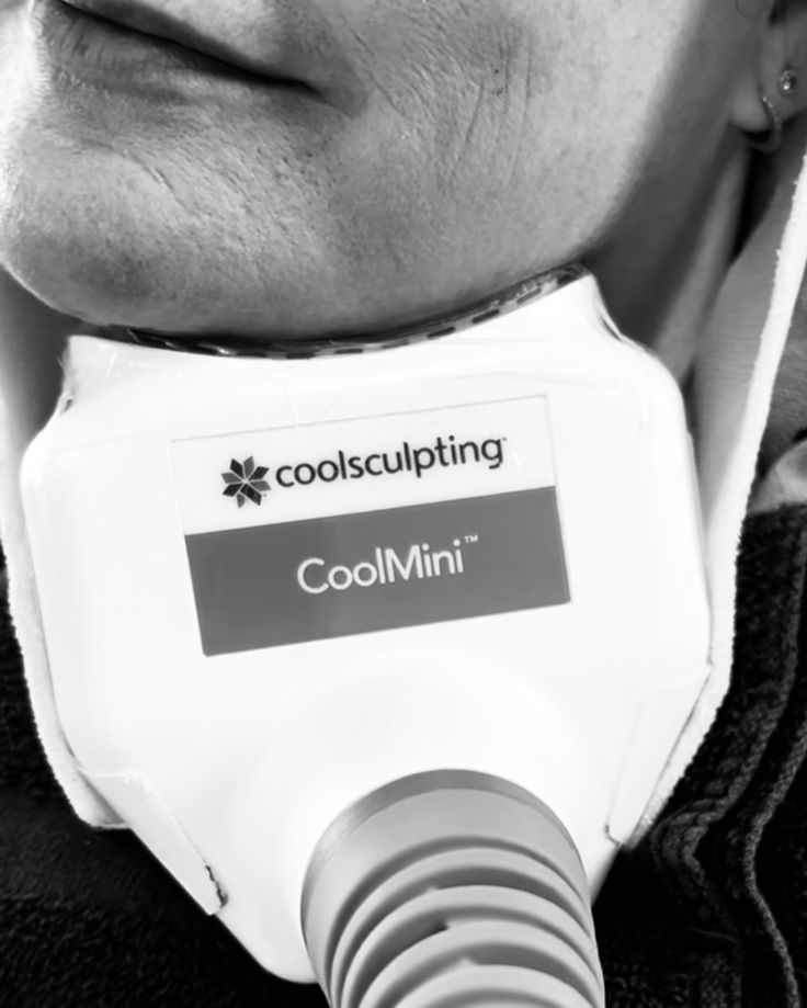 CoolSculpting at Lotus Beauty Center LLC in Eagle Pass, TX