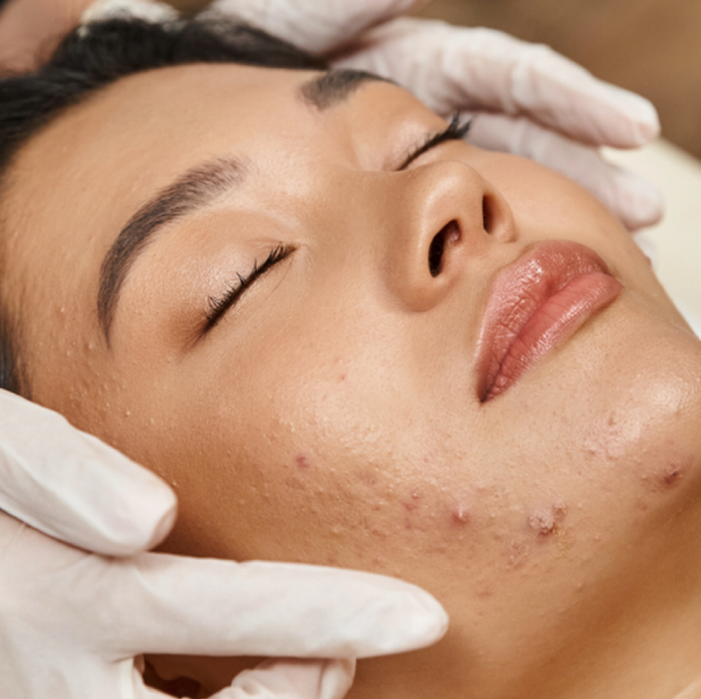 The Acne Facial at REVIVED SKIN ESTHETICS in CYPRESS, CA