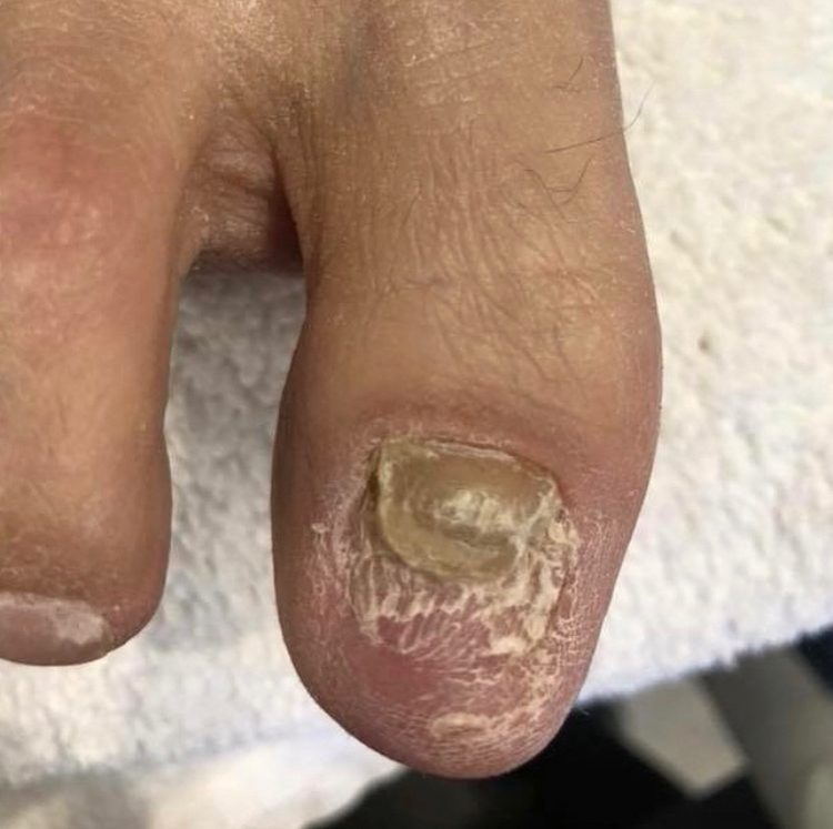 ToeNail Reconstruction