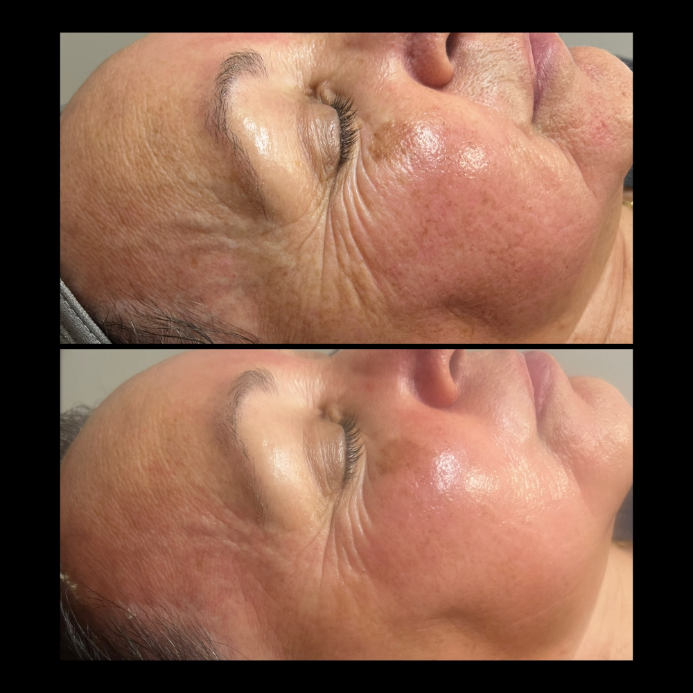 Anti- Aging “Botox” Facial