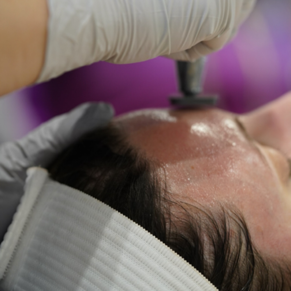 Microchanneling + Dermaplane at Skin By Carly in LaFayette, GA