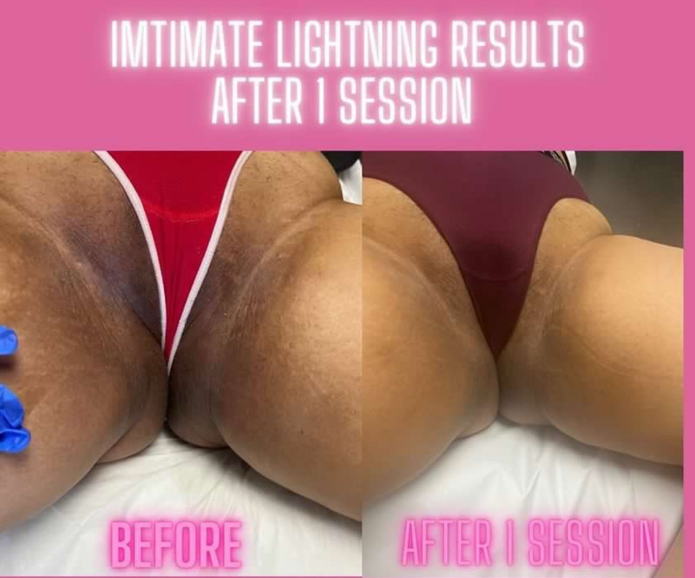 Even Glow Skin Treatment at Of The Rose Esthetics in Fresno, CA