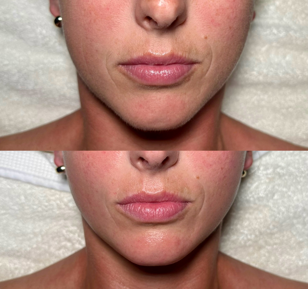 Dermaplaning Facial