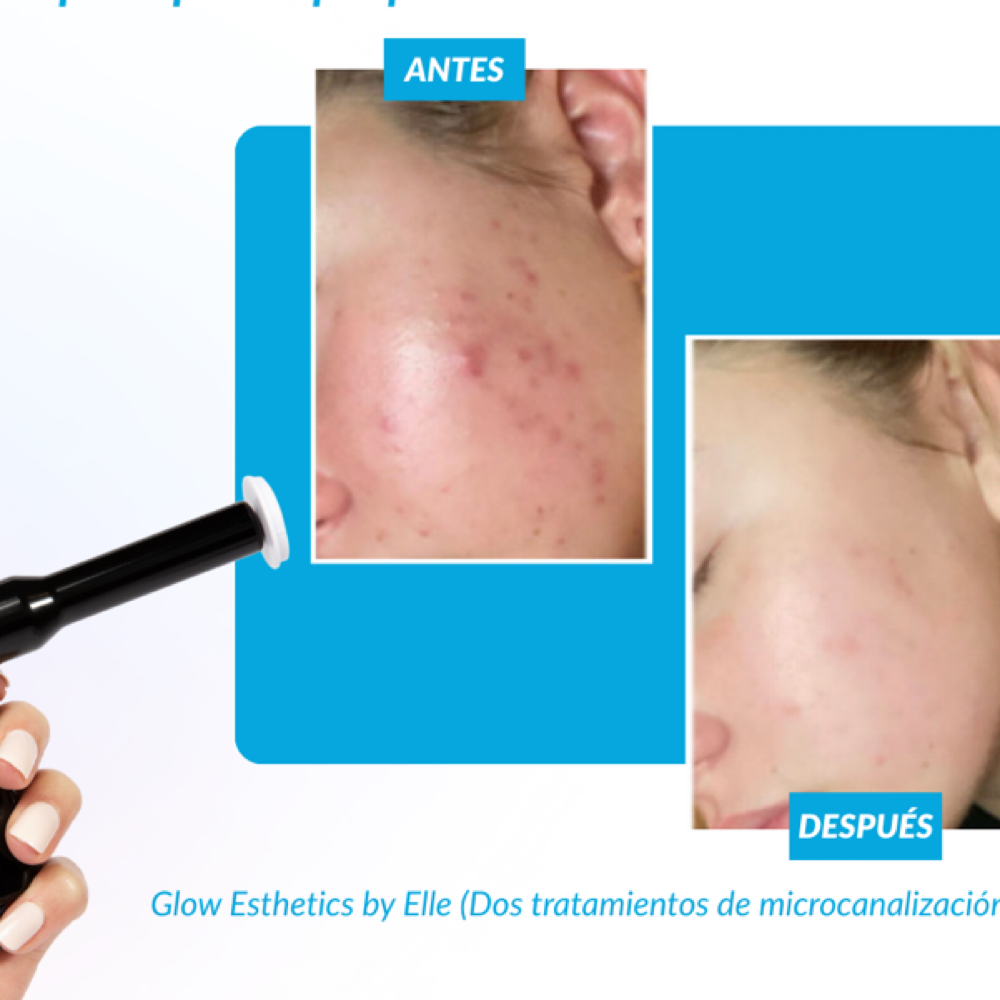 Procell Microchanneling Treatment at Golden Cloud Esthetics in Whittier, CA