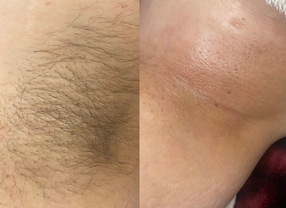 Underarm Wax