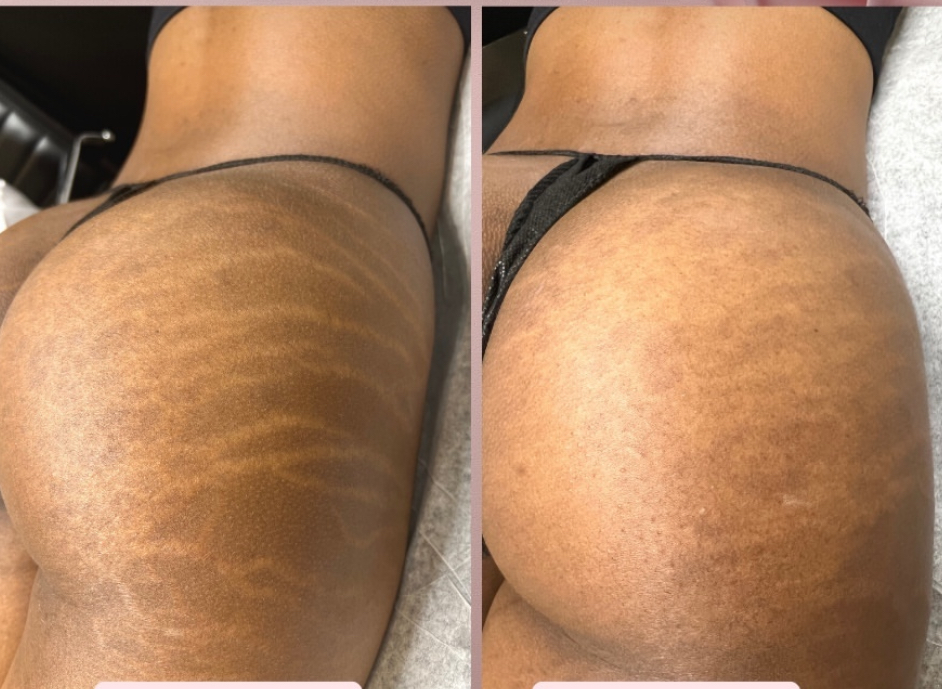 Stretchmark INKLESS