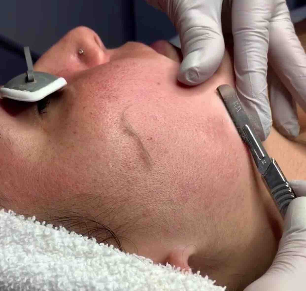 Dermaplaning Facial