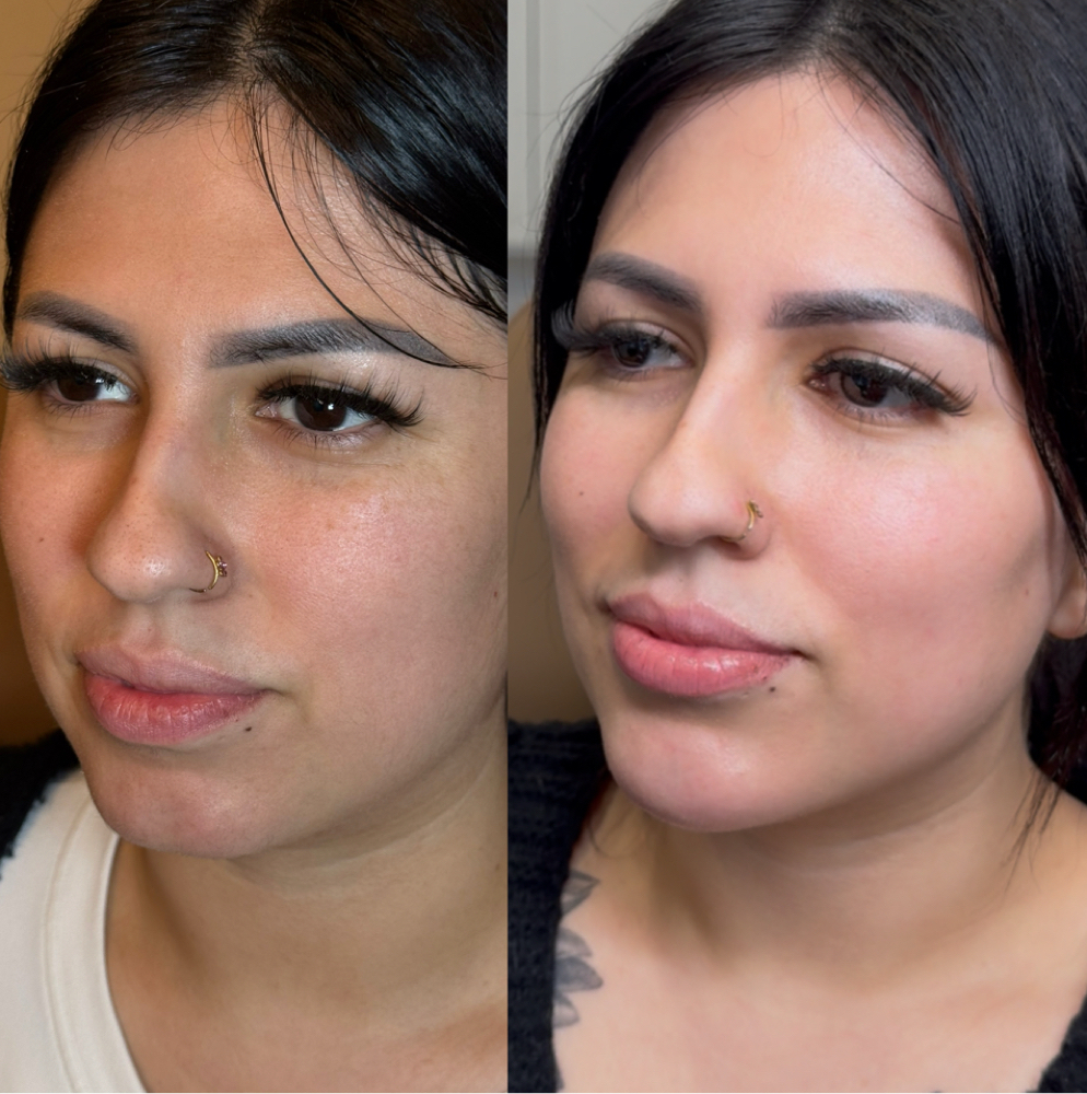 Facial Balancing/Dermal Filler at Lace Skn in West Lake Hills, TX