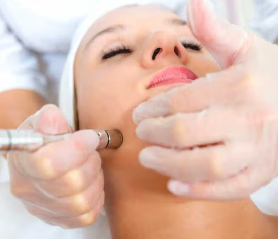 Microdermabrasion