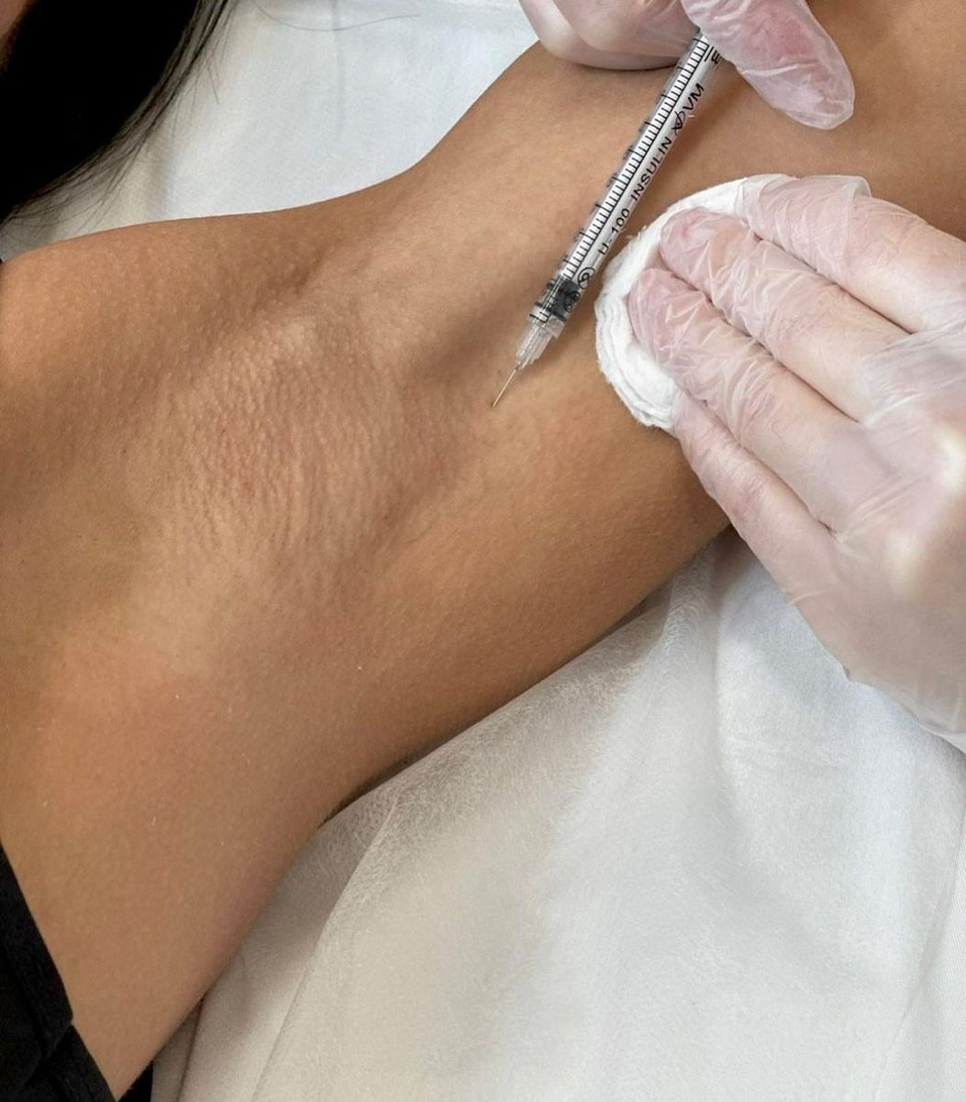 Botox® for Underarm Hyperhidrosis