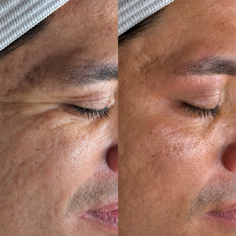 NanoStamp Microchanneling at Salt + Light Skincare in Atascocita, TX