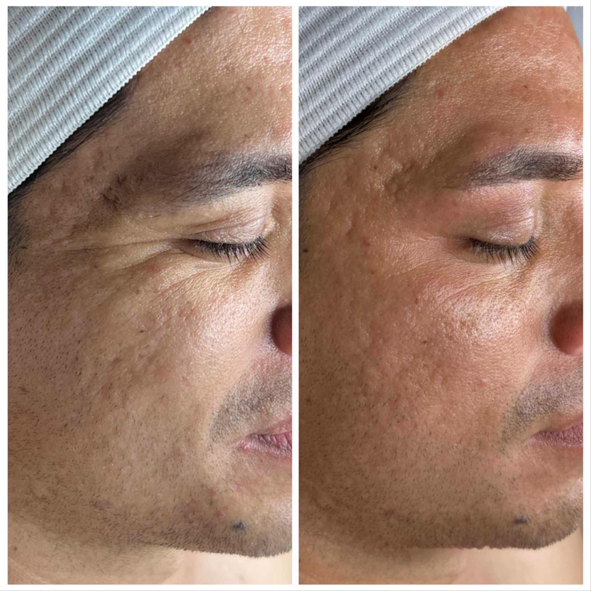 NanoStamp Microchanneling at Salt + Light Skincare in Atascocita, TX