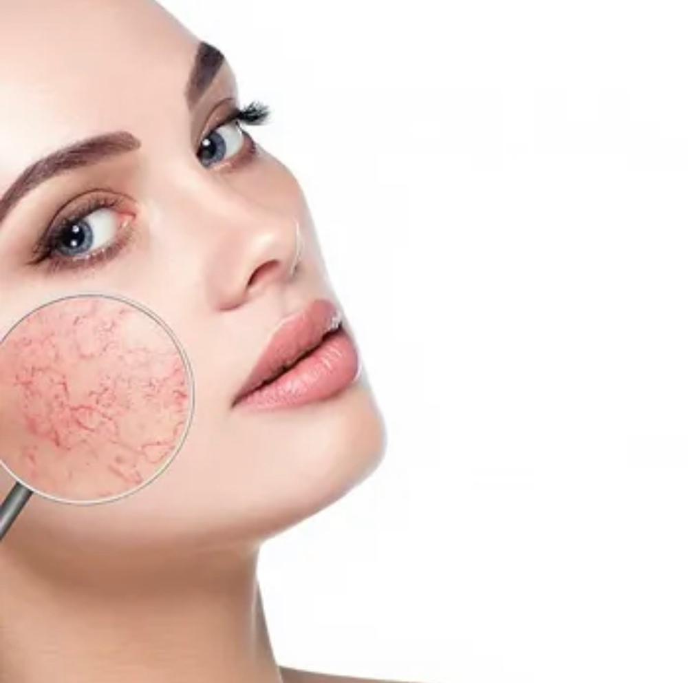 Rosacea Facial