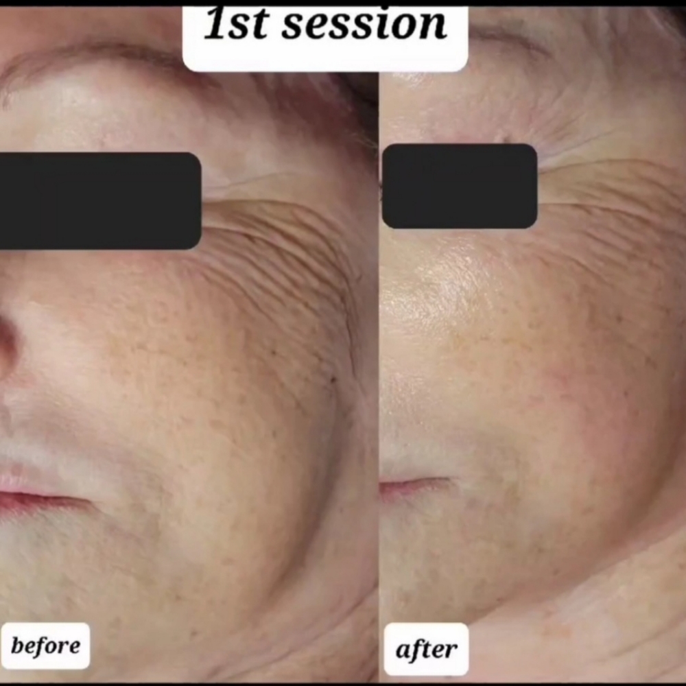 Mini Face Lift Treatment