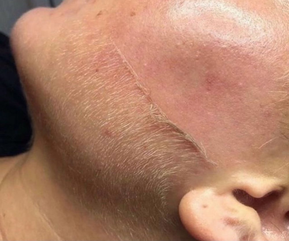 The Luxury Derma-plane Facial