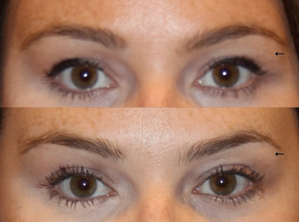 Botox Brow Lift at PuraGlow Aesthetic in Oklahoma City, OK