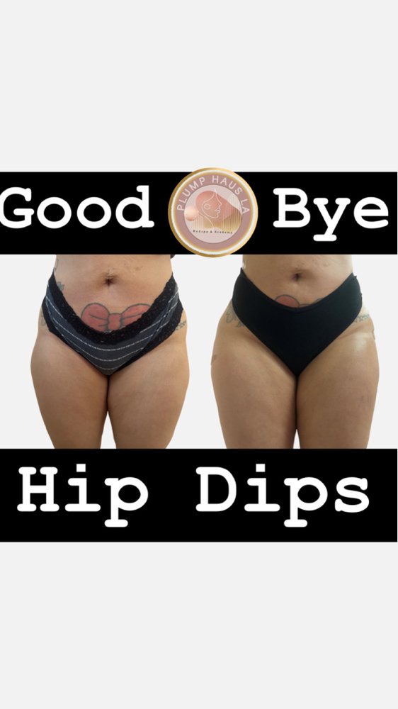 Hip Dip Filler 150 mls Each Hip