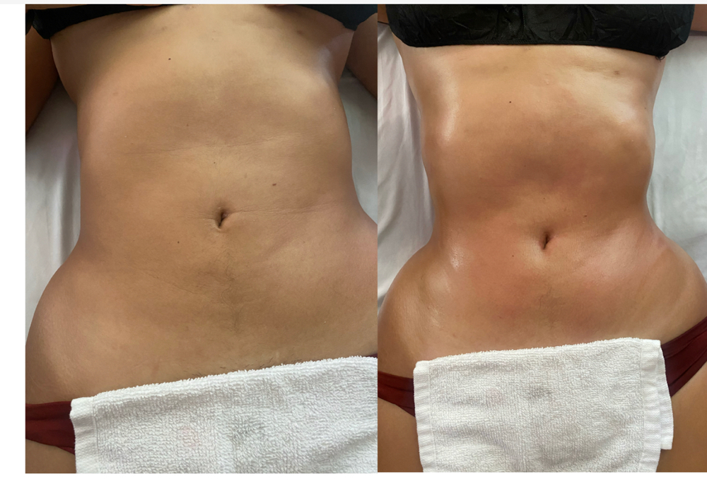 1 Abdomen, Waist and Back Madero