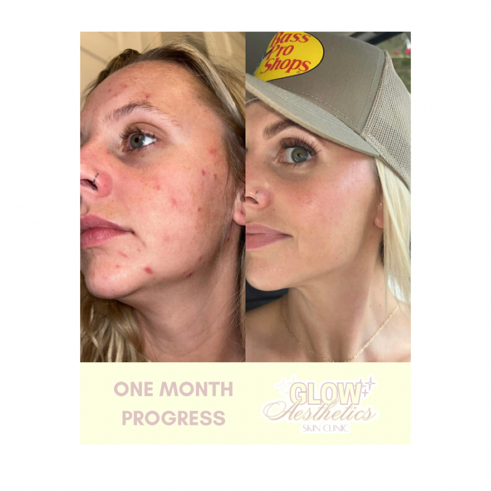 Acne Bootcamp Intro Treatment at Glow Esthetics by Alyvia in LaGrange, GA