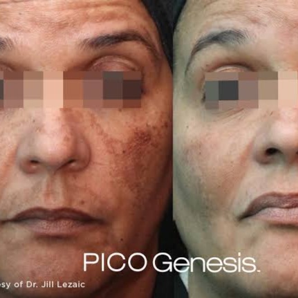 Pico Genesis (Skin Resurfacing) at Corrective treatments + professional skincare in Atlanta, GA