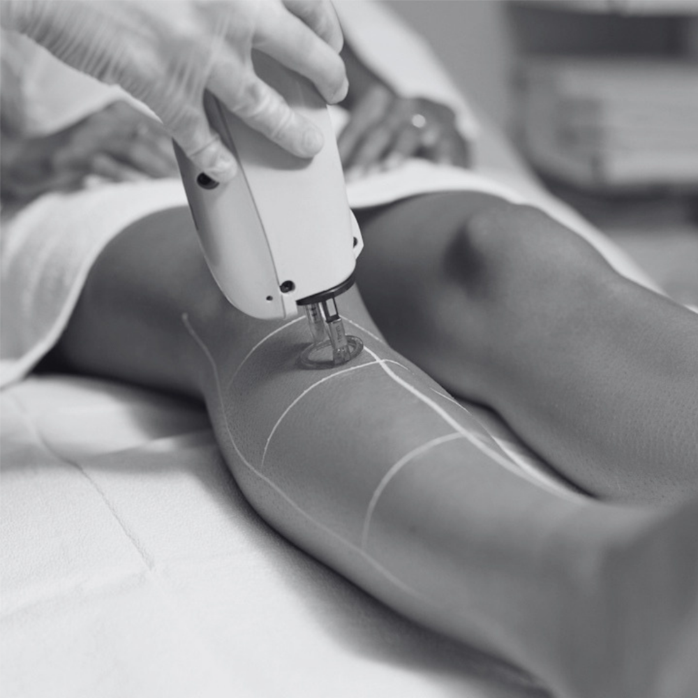 Laser Hair Removal - Legs at Kietre Wellness & Aesthetics in North Las Vegas, NV