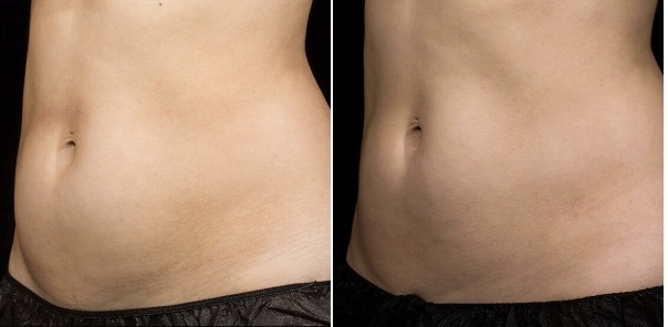 Non-Surgical Body Lipo